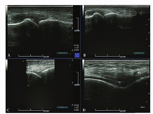 痛风性膝关节炎能治好吗,痛风性膝关节炎肿胀的治疗