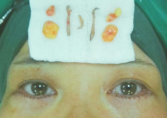 眼袋去除脂肪手术的3d演示,眼袋手术怎样快速消除淤血