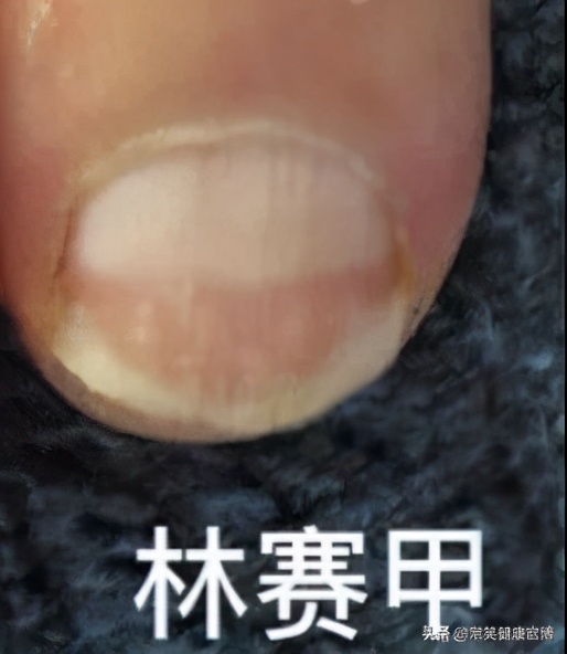指甲出现各种问题的图片,指甲出现这些症状可能是灰指甲