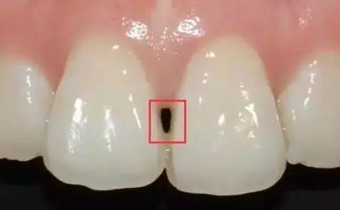 口腔医生容易得的病,口腔溃疡会引起牙齿萎缩吗