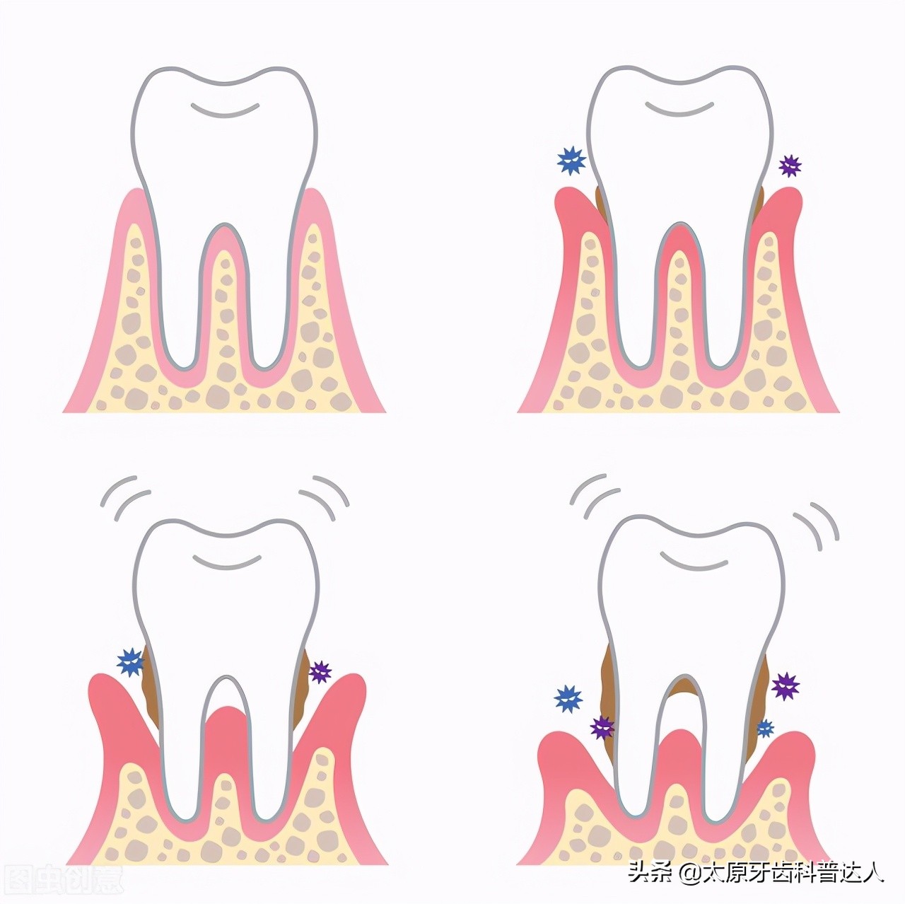牙周病造成松动怎么办,牙周病牙齿已经松动可以抹什么药