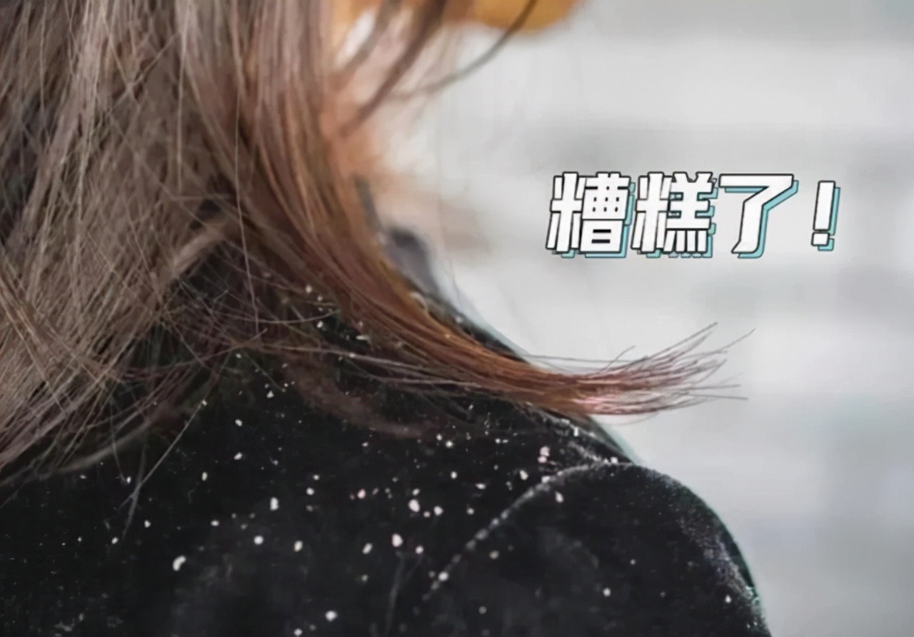 女子用硫磺皂洗三个月的头,女子坚持半年硫磺皂水洗头