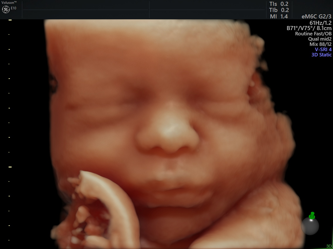 孕期超声,孕期超声一定要做吗