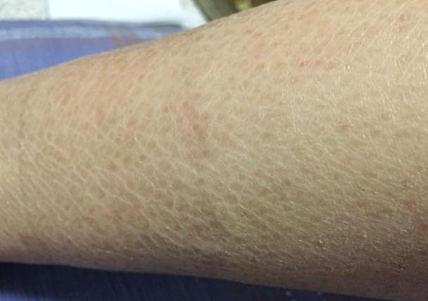 秋冬保湿去鸡皮死皮,瑕疵皮冬季护肤