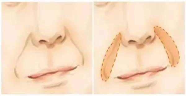 鼻唇沟深做什么手术可以改善,除了填充怎样改善鼻唇沟塌陷