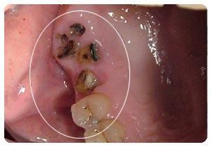 老人满口牙残根怎么办,70岁老人拔残根牙有危险吗