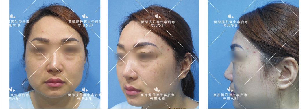 去眼袋苹果肌提升变化图,30岁面部轻微下垂眼袋泪沟