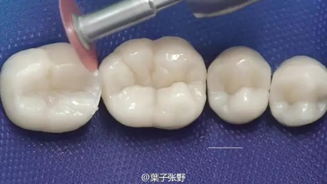 补牙疼吗补牙过程图,补牙全部过程是什么样子的