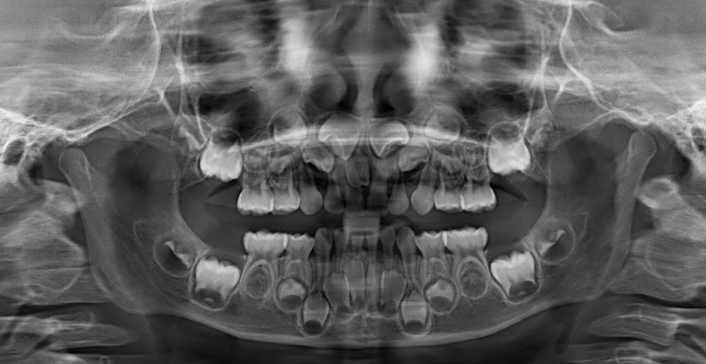 小孩看牙拍片辐射影响大吗,拍牙片对儿童辐射大么