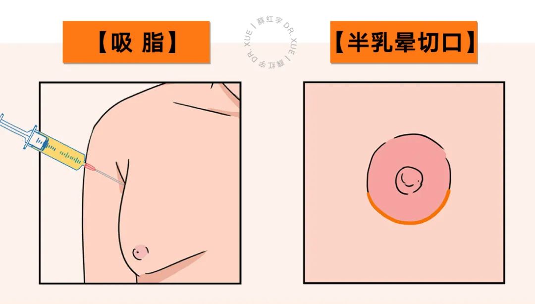 乳房缩小整形适合人群,乳房缩小术可能造成的并发症