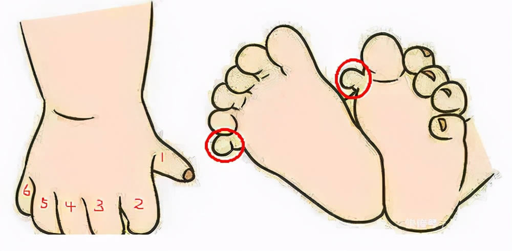 灏忓澶氭寚鐣稿舰鎬庝箞娌荤枟,鍎跨澶氭寚鐣稿舰鏈夊繀瑕佸垏闄ゅ悧