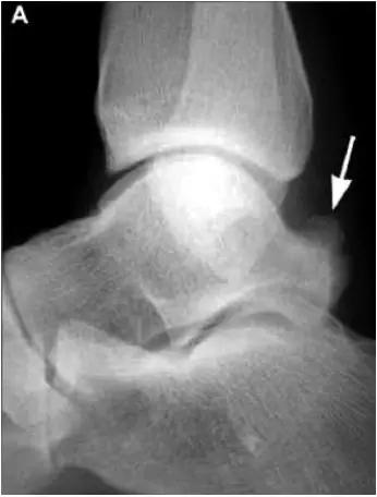 踝关节撞击症问诊,踝关节内侧撞击综合症位置图