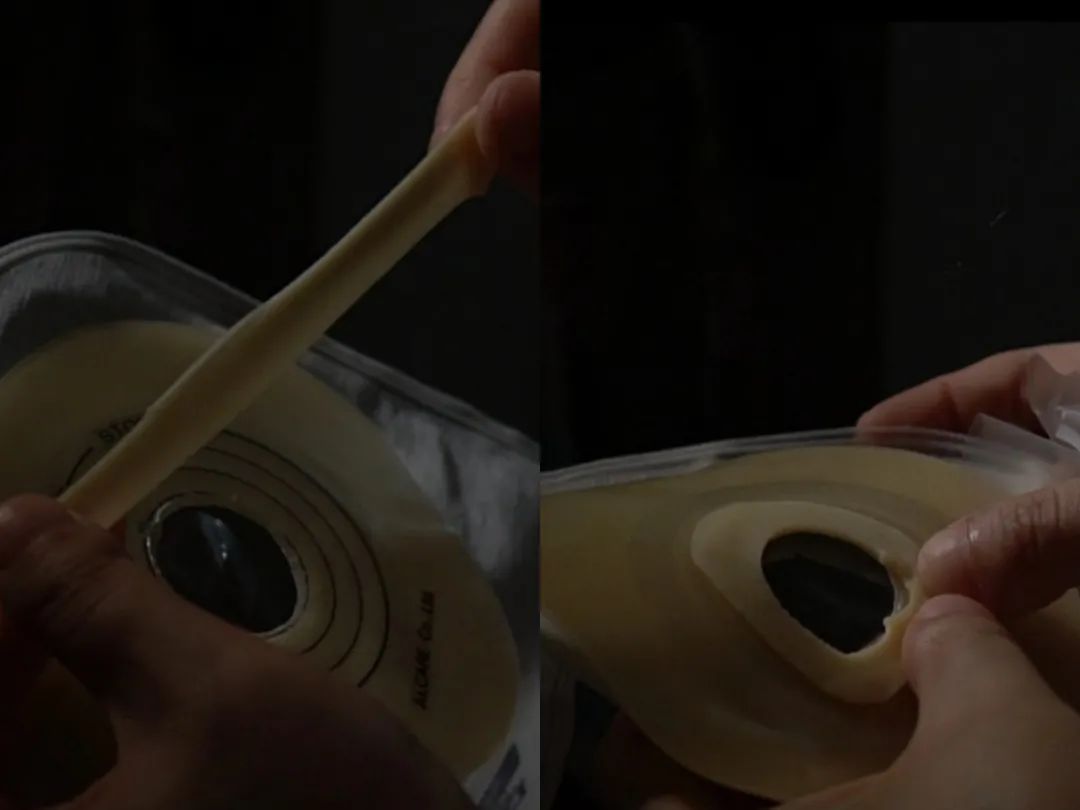 肠造口护理用品使用方法照片,造口护理技术操作需要几分钟