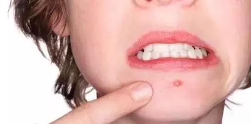 闭口粉刺痘痘黑头白头的区别,开口粉刺和闭口怎么区分