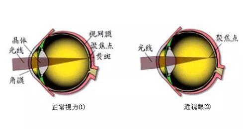 近视眼手术后的亲身经历2020,近视眼手术10年后的亲身经历