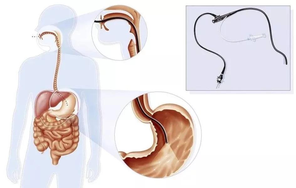 胃镜检查很痛苦？一文带你了解胃镜全过程，无须望而生畏