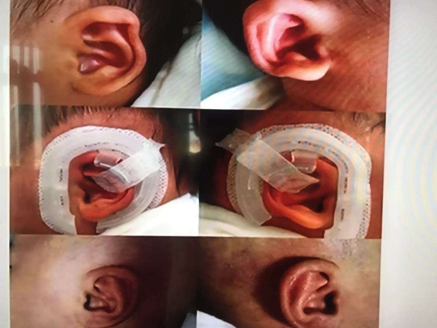 耳朵软骨畸形能矫正吗,新生儿耳朵畸形矫正费用大概多少