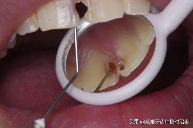 根管治疗后牙齿还能有多长寿命,根管治疗以后牙齿还能用几年