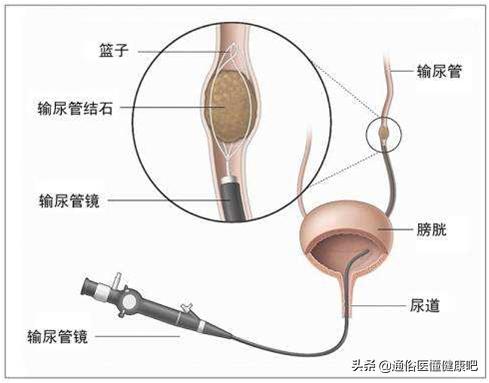体外碎石冲击波与超声波哪个好,体外冲击波碎石与微创碎石哪个好