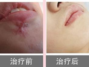 原来疤痕处感染化脓了怎么处理,刚刚形成的疤痕疙瘩怎么治疗