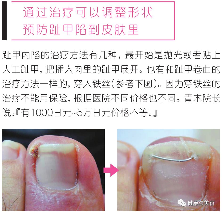 脚趾甲已经剪成圆形怎么办,脚趾甲长进肉怎么剪才不会痛