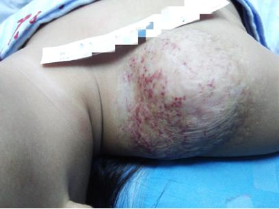 女婴右肩斑块连结混合型血管瘤生长迅速