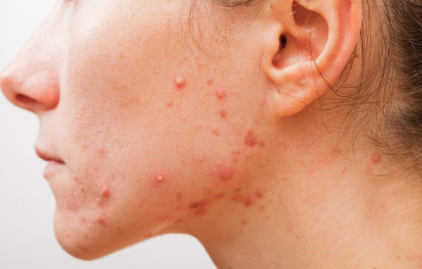 治疗痘痘到哪个医院好啊,怎么治疗痘痘最经典有效