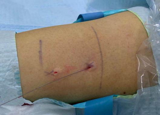 开展picc置管技术,隧道式picc置管技术专家共识