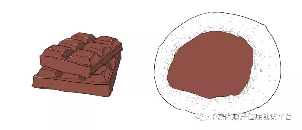 卵巢囊肿巧克力怎么形成的,卵巢长了巧克力囊肿是怎么回事