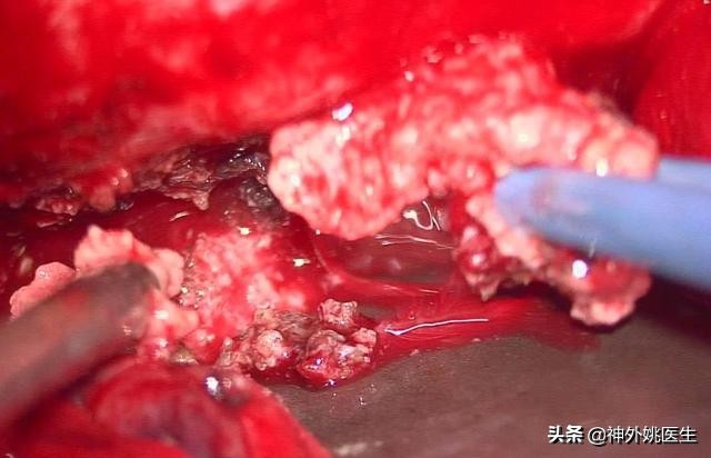 脑膜瘤是什么原因引起的啊,脑膜瘤手术治疗全部大概多少钱