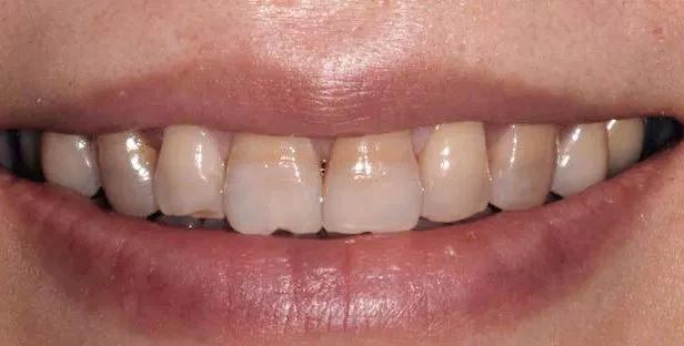 刷牙时一个小窍门彻底告别黄臭牙,刷牙的时候放点小苏打牙会变白吗