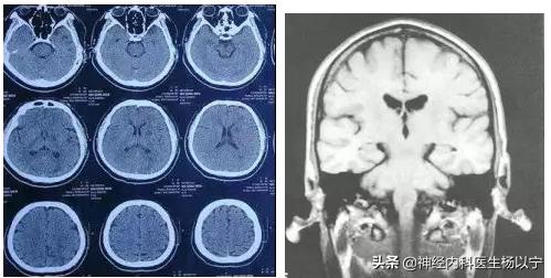 上眼睑无力老是提眉,一侧抬眉引起轻度肌无力能恢复么