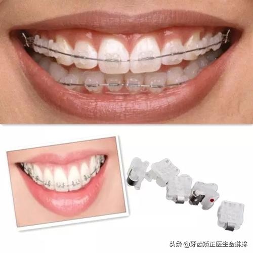 换牙牙齿从里面长出来并且歪了,换牙被挤歪的牙齿会自己长回去吗