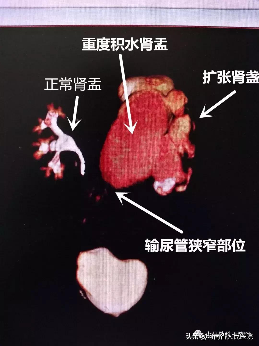 肾积水手术需要插几天尿管,宝宝重度肾积水