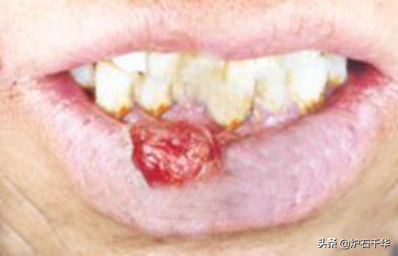 槟榔的危害视频,槟榔的危害大还是吸烟的危害大