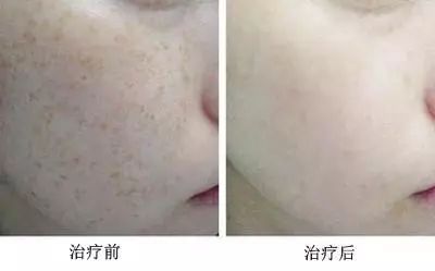 怎样祛斑是MM们的长久烦恼，教你几招
