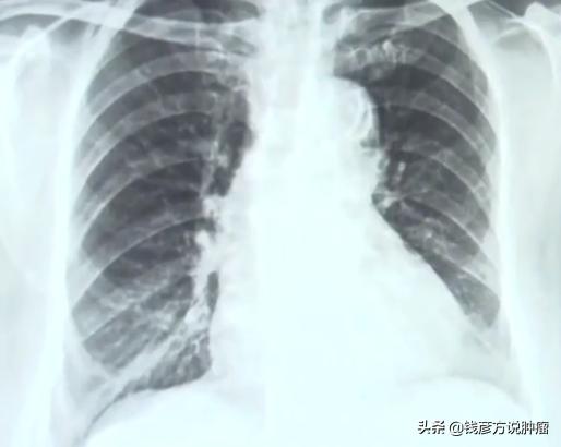 经历3次癌症手术的报道,经历两次肿瘤化疗