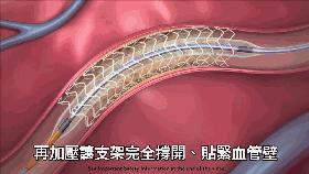 足球球员心脏骤停抢救成功案例,足球赛老人心脏骤停
