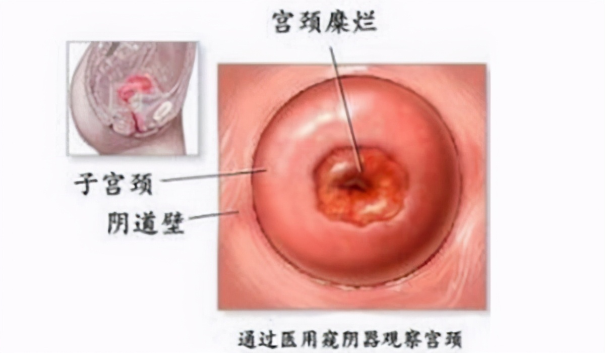 hpv感染合并宫颈息肉,hpv感染合并慢性宫颈炎