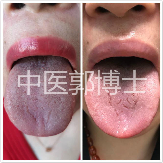 围绝经期崩漏中医治疗,40岁闭经中医辨证