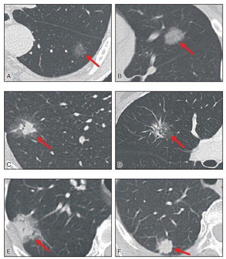 肺结节中的ggo代表什么,肺结节ggn与ggo有什么区别