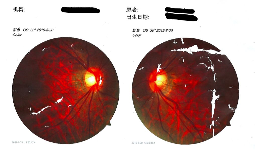 左眼突然看不见东西了已经一天了,左眼突然看不见两分钟后又看清了