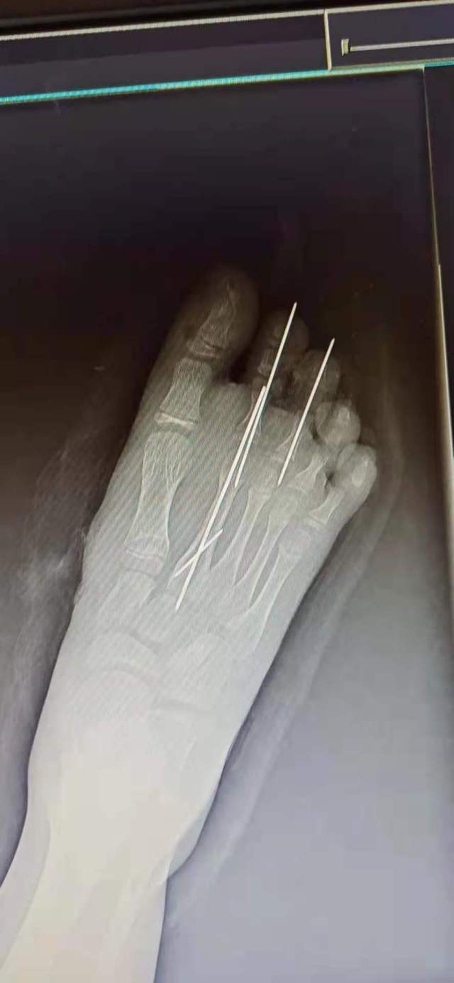 父亲转身接了个电话，女儿少了两根脚趾！医生提醒，断指（趾）保存方法及再植“黄金时间”十分重要