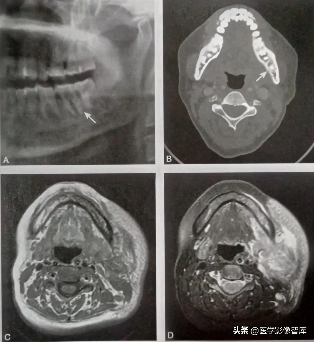 牙源性颌骨骨髓炎x线诊断,牙源性上颌骨骨髓炎很严重吗