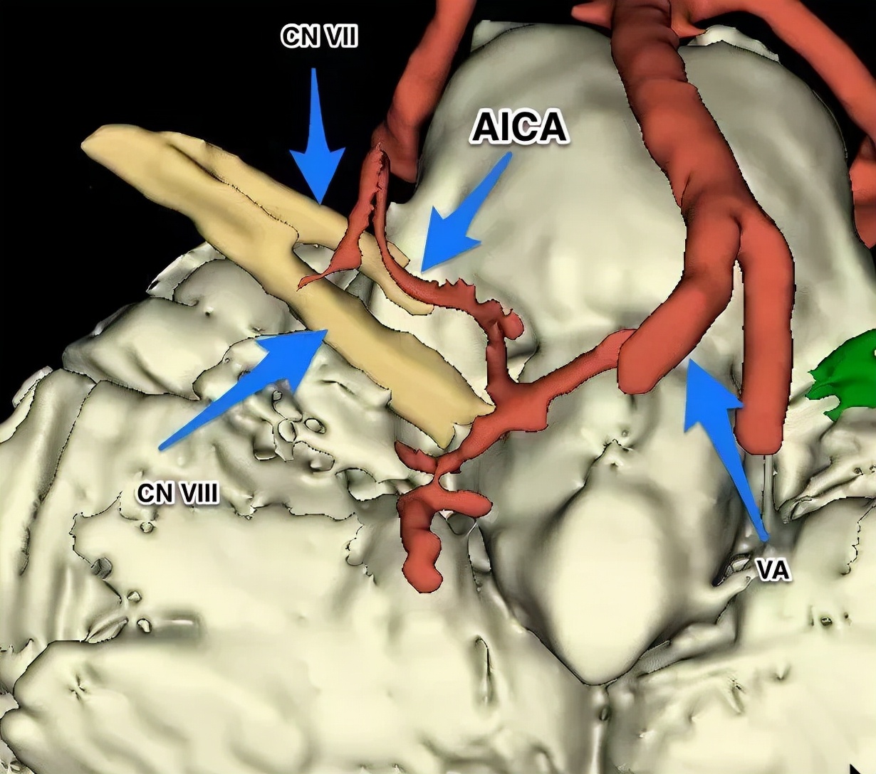 面肌痉挛偏方大全,面肌痉挛健康科普短视频