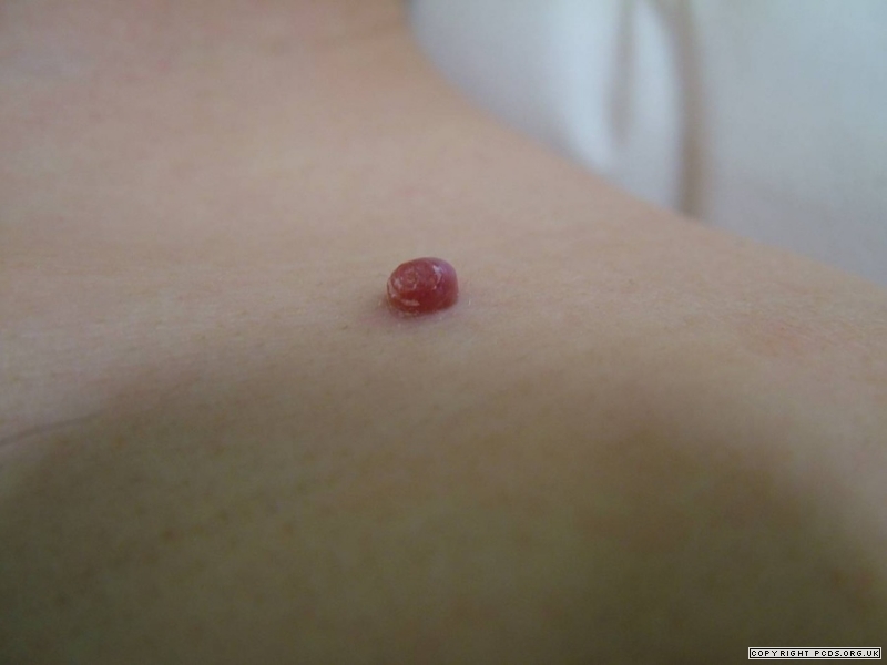 肚皮上长凸起的红色的痣要不要紧,前胸后背都长红色的痣是什么原因