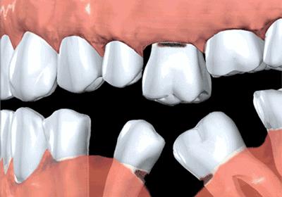 拔牙后一年再种植会有影响吗,拔牙一年后再镶可以吗