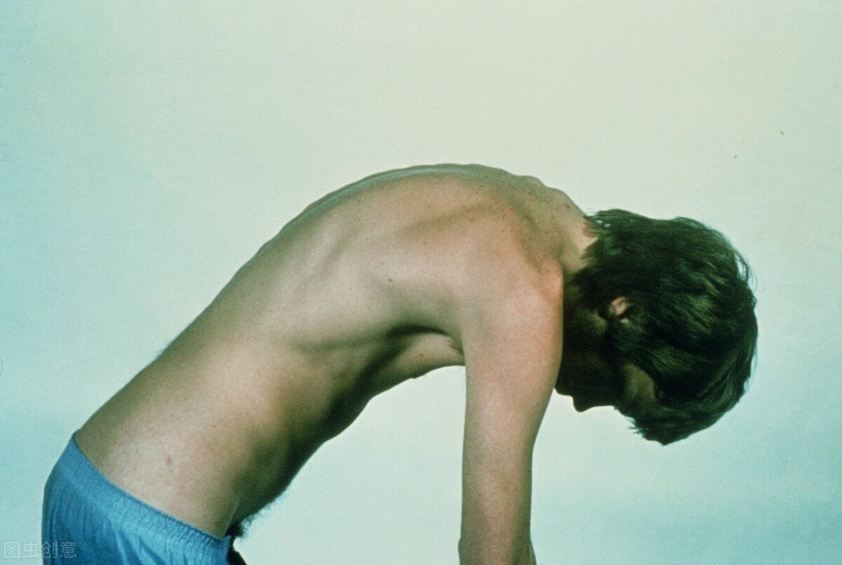 中医治疗强直性脊柱炎如何,中医治疗强直性脊柱炎