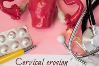 “宫颈糜烂”不是病，为什么要治？检查出来了要怎么办