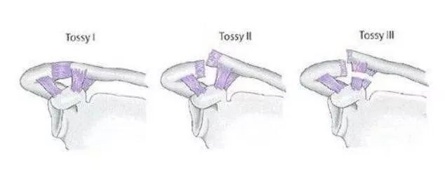 肩锁关节脱位治疗,肩锁关节脱位
